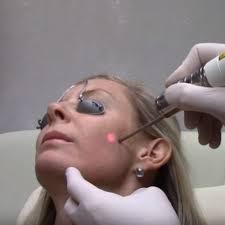 Green toning Tratamiento para Pecas, Melasma y tono desigual