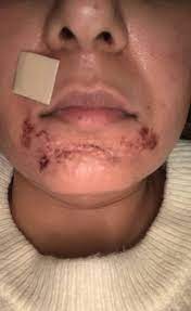 Rinse the area with cool water for 15 minutes or more to remove the chemical and neutralize the area. The Painful Lessons I Learned After The Ordinary Gave Me Chemical Burns Dazed Beauty