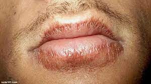 Bibir hitam ataupun adanya flek hitam pada bibir, bisa saja terjadi akibat adanya faktor genetik alias faktor keturunan. Di Sekitar Bibir Anda Berwarna Gelap Coba Cara Ini Health Liputan6 Com