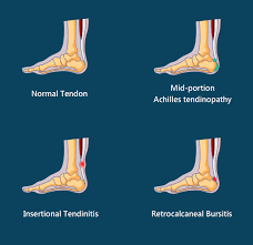 Braceability sleeping stretch boot | plantar fasciitis night foot splint and adjustable achilles tendonitis brace for fascia, tendon and calf stretching, heel spur or arch pain treatment (medium). Insertional Tendinitis Massage Treatment In The Achilles Tendon