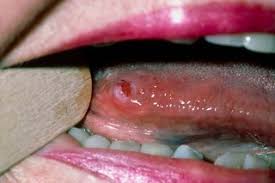 Image result for white cancer on tongue)