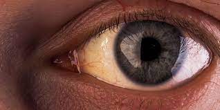 Why Are The Whites Of My Eyes Discolored American Academy Of Ophthalmology