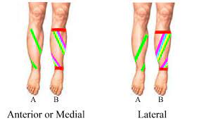 Shin Splints Taping Shin Splints Taping Shin Splints Shin Splint Exercises