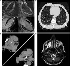 Cardiomyopathies, myocarditis, and pericardial disease. Multi Modal Investigation To Support Eosinophilic Granulomatosis With Download Scientific Diagram