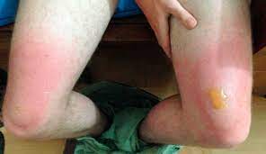 It is caused by allergenic polypeptides in mosquito saliva, and therefore is not contagious. Common Bite Bizarre Rash Wilderness Environmental Medicine