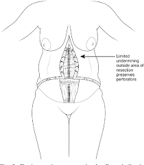Specialist plastic surgeons dedicated to best care, excellence in customised surgery planning and education in breast, tummy, body, face, eye surgery. Figure 3 From The Fleur De Lis Abdominoplasty Semantic Scholar