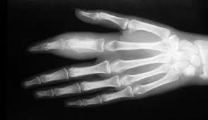 Image result for periostitis