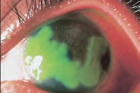 Herpes simplex virus (hsv) ocular infections can cause inflammation of the retina (retinitis), iris and associated uveal tract (iritis or uveitis), cornea (keratitis), conjunctiva (conjunctivitis), eyelids (blepharitis), and surrounding skin (periocular dermatitis). Geographic Corneal Ulcer Caused By Herpes Simplex Virus Keratitis Download Scientific Diagram