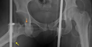 Image result for Hip Dislocation