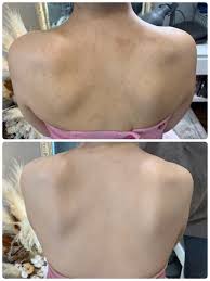 背中に悩む花嫁さんの最終手段！ボディメイクで一瞬でキレイな背中に！ | ゆる〜く花嫁録♡