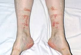#purpura ist definiert als exanthem aus petechien. Sport Ist Gesund Irritiert Aber Manchmal Die Gefasse Springerlink