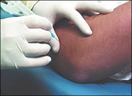 Image result for Epicondyle Injection