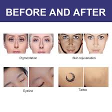 Hyperpigmentation is visible, but the tattoo is slowly fading. Best Vertical Q Switch Nd Yag Laser Tattoo Removal Machine Pigmentation Treatment Instrument China Nd Yag Yag Laser Made In China Com