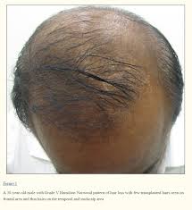 How often can i microneedle? How To Use Derma Roller And Minoxidil To Regrow Hair