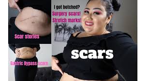 Gastric bypass is surgery that helps you lose weight by changing how your stomach and small intestine handle the food you eat. Botched Surgery Scar Stories Gastric Bypass More Youtube