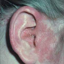 Rash Around Ear Mdedge Family Medicine