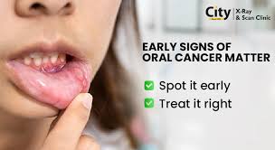 Image result for gum cancer symptoms