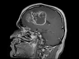 Resultado de imagem para glioblastoma