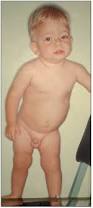 Image result for Inguinal hernia child