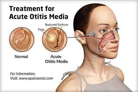 التهاب #الأذن #الوسطى : #تشخيصه سهل ..... #علاجه بسيط....#مضاعفاته خطيره  #اولاً : كيف #يحدث التهاب الأذن الوسطى ؟ تنتقل الجراثيم الموجودة في البلعوم  والأنف عن طريق نفير اوستاش وبسبب سوء وظيفة هذا