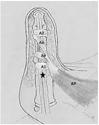 Flexor tendon injuries are traumatic injuries to the flexor digitorum superficialis and flexor digitorum profundus tendons that can be caused by laceration or trauma. Closed Rupture Of The Flexor Tendon Pulleys Of The Thumb Clinical Imaging