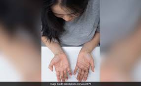 Some medications used to treat thyroid issues can also cause hair thinning. World Thyroid Day 7 Natural Ways To Prevent And Treat Hair Loss Due To Hypothyroidism