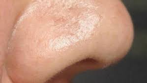 Cheagurile de sânge din nas nu apar în toate cazurile, dar destul de des. Credea Ca Are Un Cheag De Sange In Nas A Inghetat Cand A Vazut Ce I A Scos Medicul Buna Ziua Iasi Bzi Ro