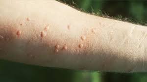 Ant Bites That Look Like Mosquito Bites Ant Bites And Stings Can Become Infected Ant Bites Remedies For Mosquito Bites Bites On Skin