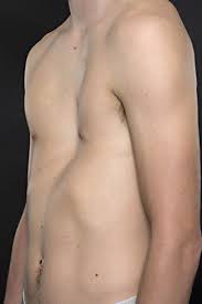 What is pectus excavatum, what is pectus excavatum chest symptoms, treatments and causes. Pectus Excavatum Thoracic Key