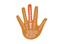 Continue elevating your finger when possible. Dislocated Finger How To Fix Types Recovery Time Buoy