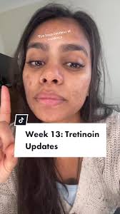 Hyperpigmentation Girl Front View