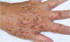 Liver Spots A Sign Of Aging Hyperpigmentation And How To Get Rid Of Brown Spots Age Spot Remedies Old Age Spots Brown Age Spots