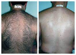 Not only are we the most trusted name in laser hair removal, ideal image is also the largest provider in the nation of coolsculpting, and ultherapy! Laser Hair Removal For Men In Pittsburgh Happel Center
