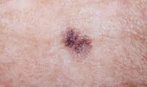 At this point, other symptoms of melanoma appear: Skin Cancer Symptoms Warning Signs Your Mole Is Melanoma How To Prevent It Express Co Uk