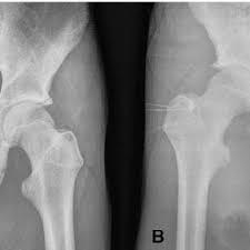 Timely, accurate diagnosis is imperative so proper treatment can be initiated. Pdf Injuries About The Hip In The Adolescent Athlete