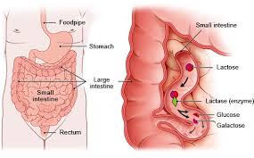 Image result for Lactase Deficiency
