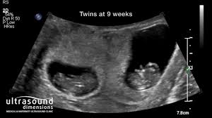 Maybe you would like to learn more about one of these? Scan Of The Week Twins At 9 Weeks Gestation Youtube