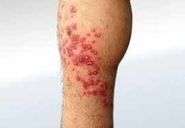 Image result for folliculitis symptoms