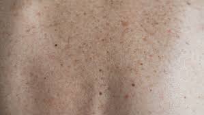 Image result for Freckled skin