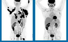 He or she may be considered cured after a certain number of years, depending on the type of leukemia. Terminal Cancer Patients In Complete Remission After One Gene Therapy Treatment
