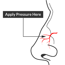 Image result for Epistaxis