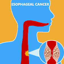 From professional translators, enterprises, web pages and freely available translation repositories. Best Cancer Hospital In India Esophageal Cancer Treatment In Coimbatore Tamil Nadu