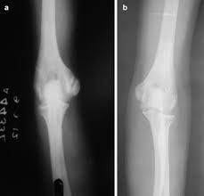 A rounded protuberance on a bone that is located upon a condyle. Tardy Ulnar Nerve Palsy After Fracture Non Union Medial Epicondyle Of Humerus An Unusual Case Journal Of Clinical Orthopaedics Trauma