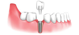 Image result for dental implant