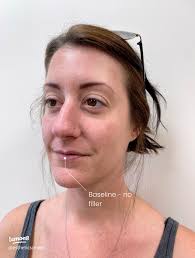 Achieve Natural-Looking Lips with Lip Filler Stacking