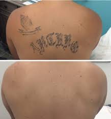 The laser tattoo removal before and after pictures shown here are of real people with real results. Before After Bareremoval