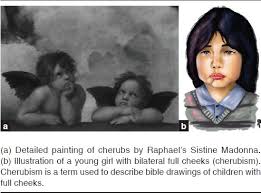It is typically a bilateral process that leads to facial, dentition and ocular abnormalities. Imaging Of Cherubism Case Report And Review Of The Literature Elshafey R Tanta Med J