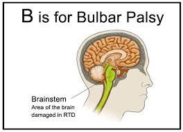 Image result for Progressive Bulbar Paralysis
