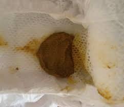 Ausscheidungen Hallohebamme