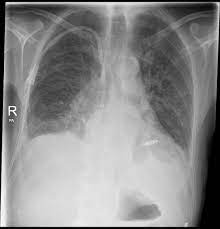Select from premium pacemaker xray of the highest quality. Wireless Pacemaker Radiology Case Radiopaedia Org